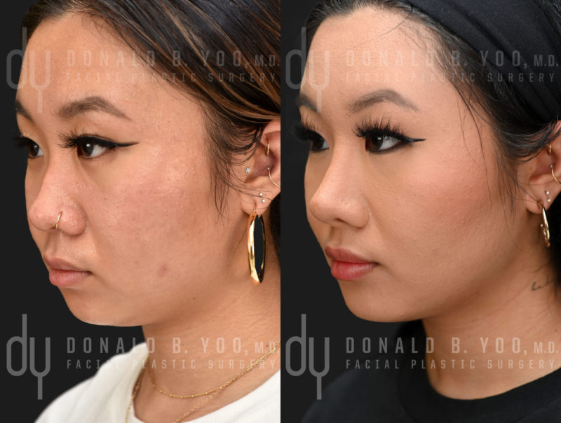 Rhinoplasty and Chin Augmentation before and after - after