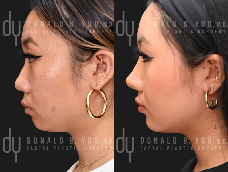Rhinoplasty and Chin Augmentation before and after - before
