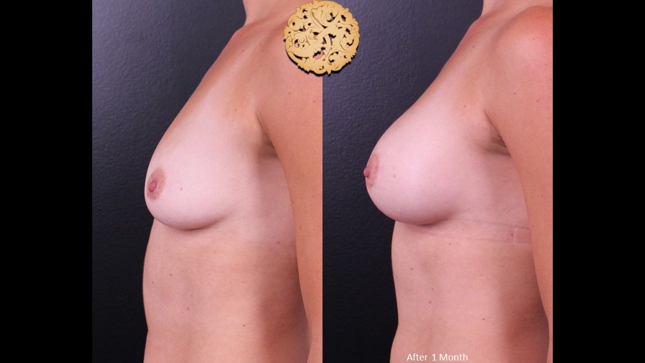 Breast Augmentation before and after - after