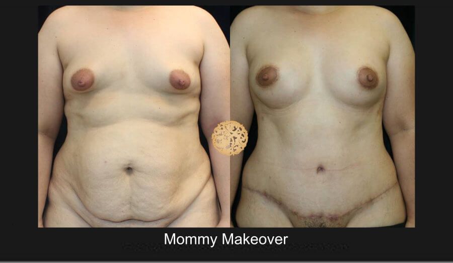 Mommy Makeover before and after - after