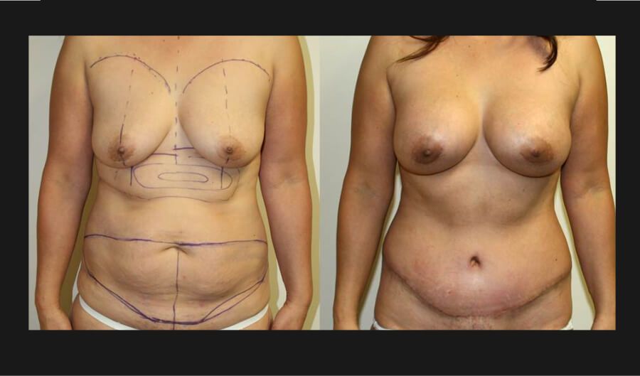 Mommy Makeover before and after - before