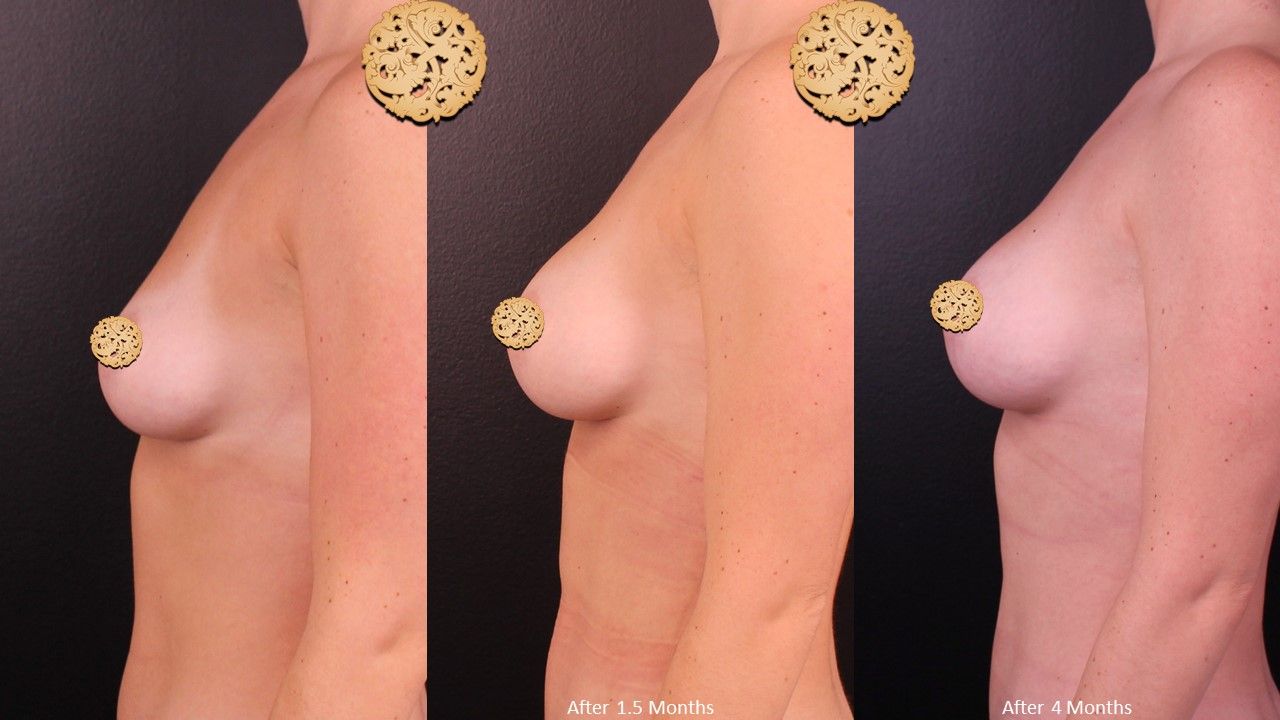 Breast Augmentation before and after - after