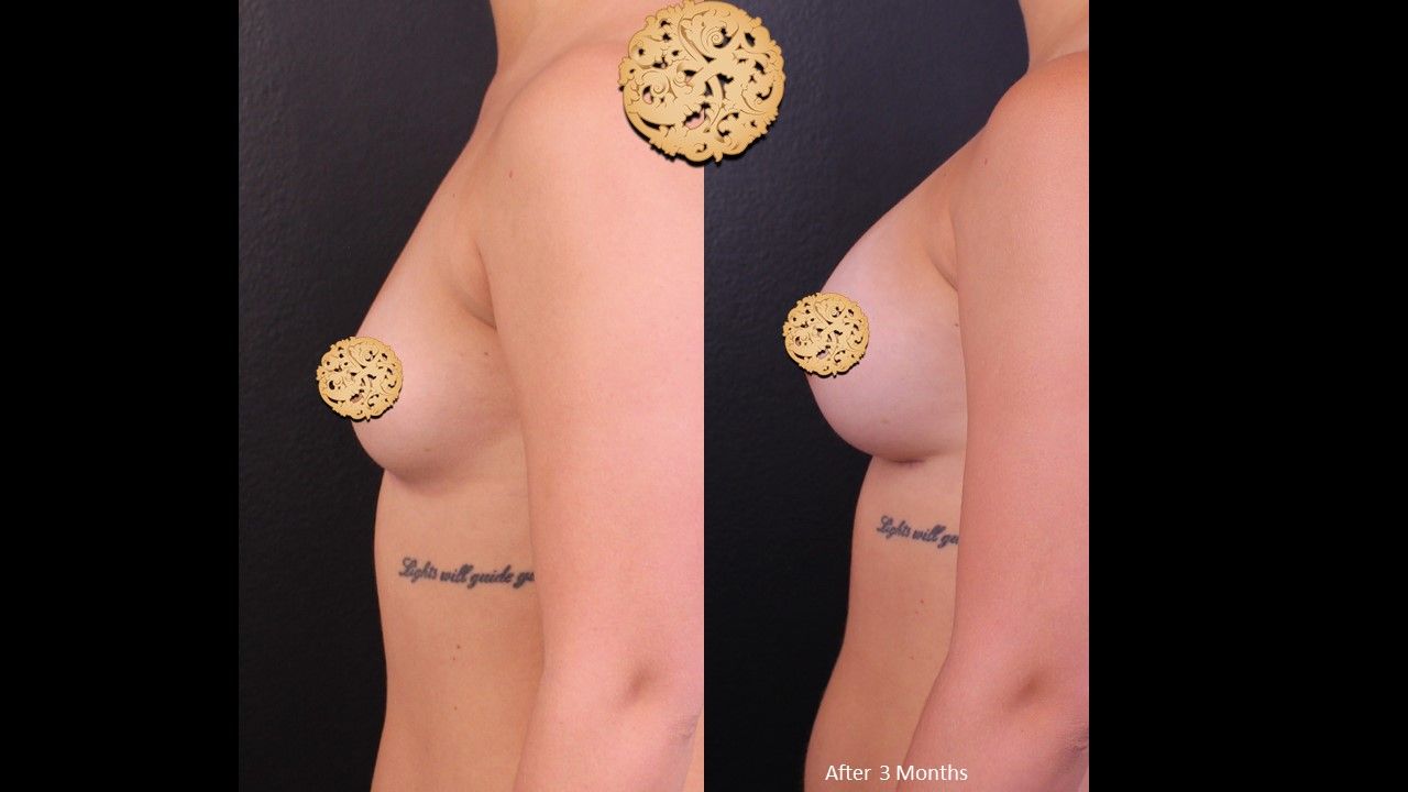 Breast Augmentation before and after - before