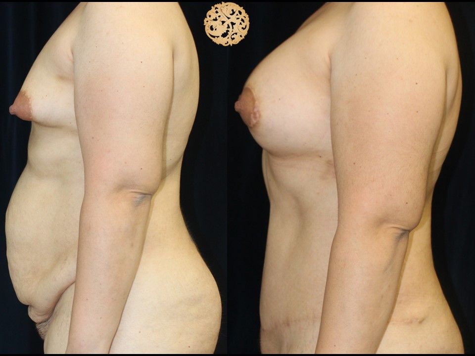 Mommy Makeover before and after - after