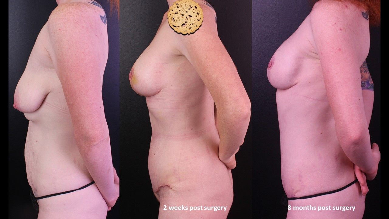 Mommy Makeover before and after - before