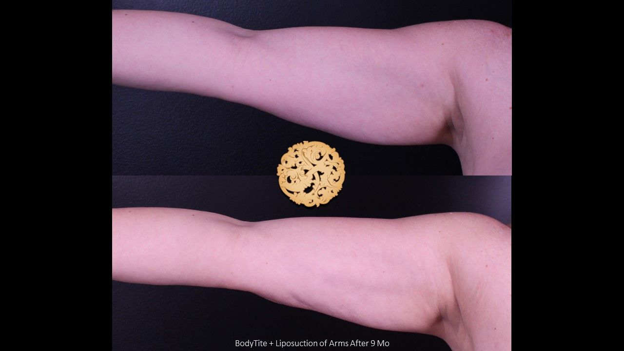 Liposuction before and after - after