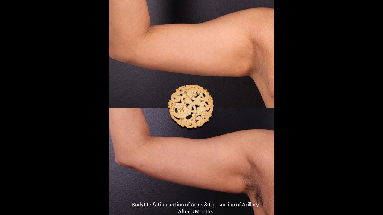 Liposuction before and after - before