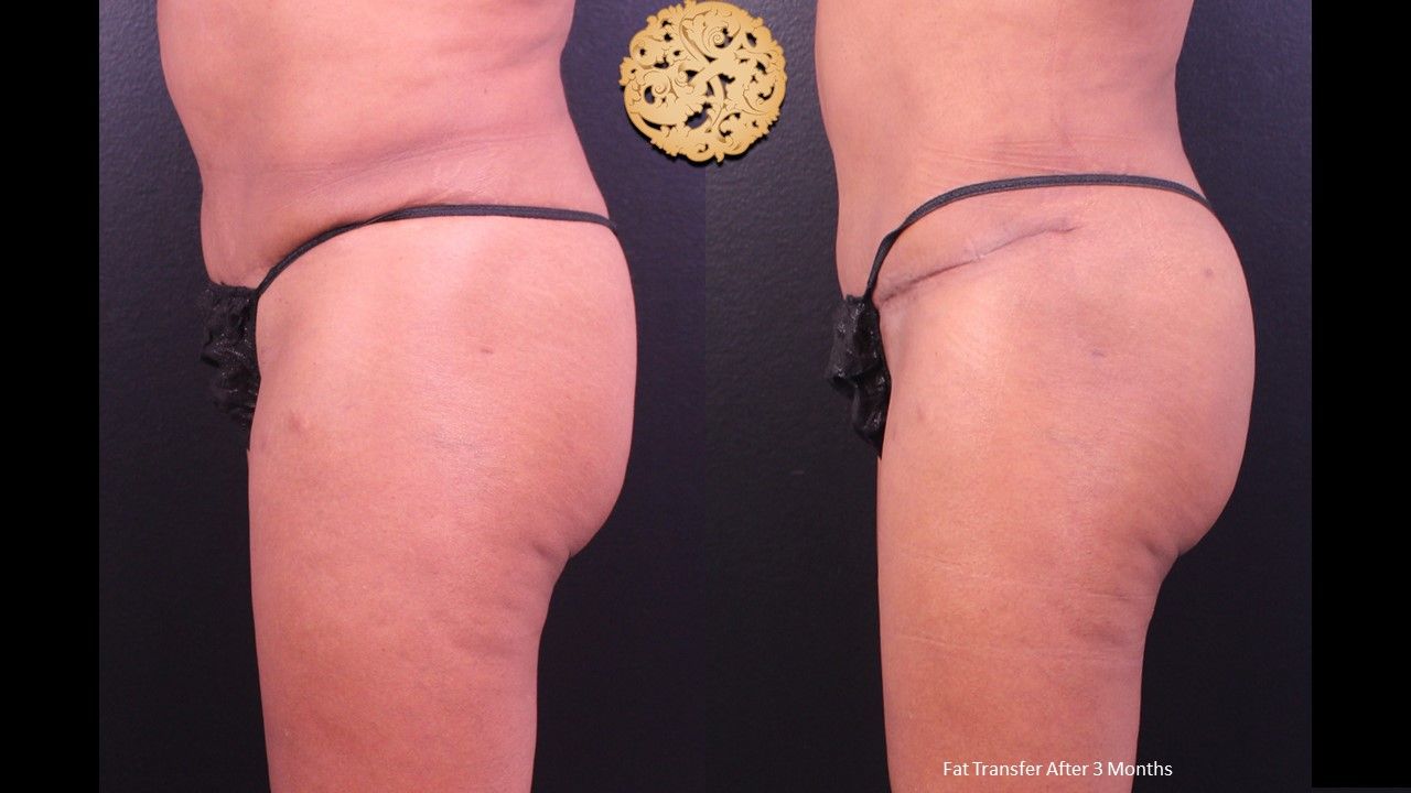 Brazilian Butt Lift before and after - after
