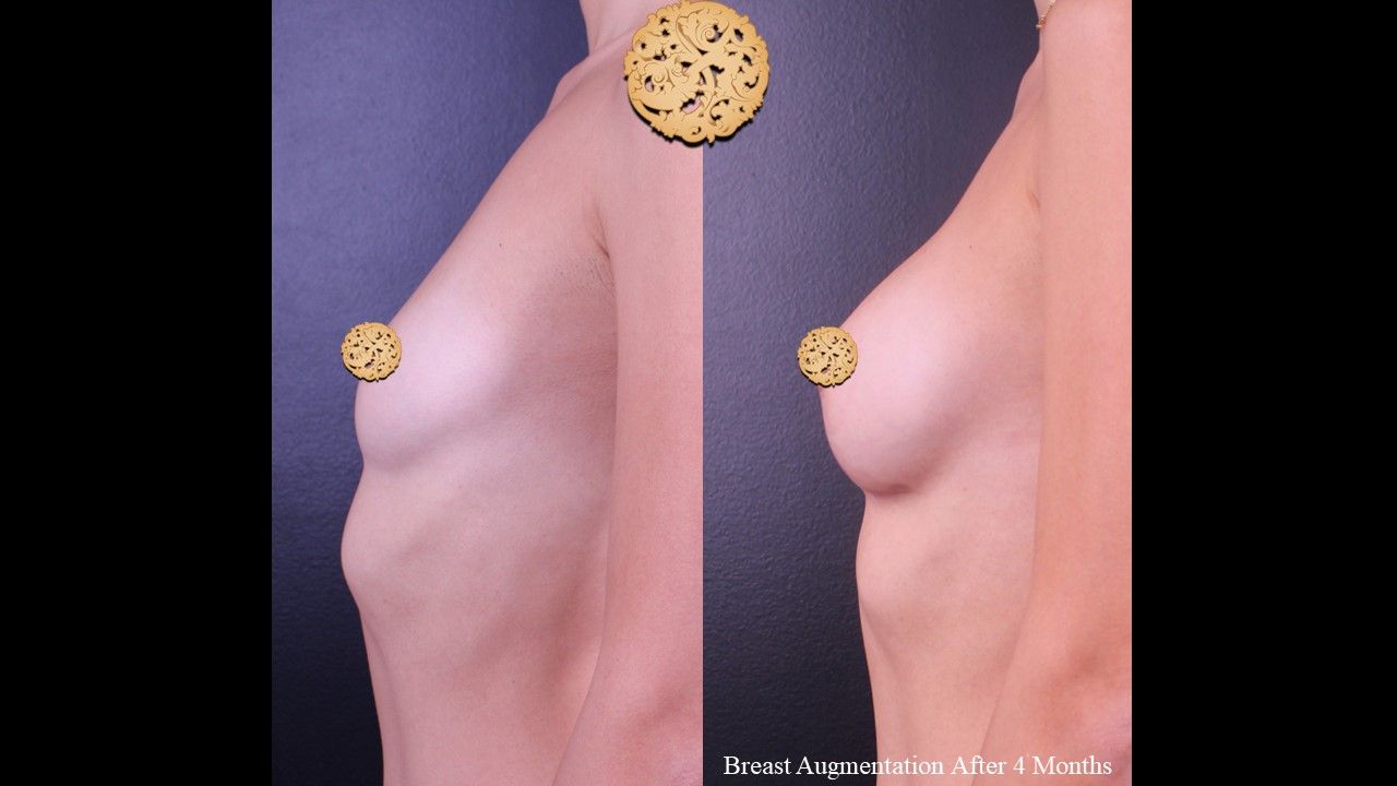 Breast Augmentation before and after - after
