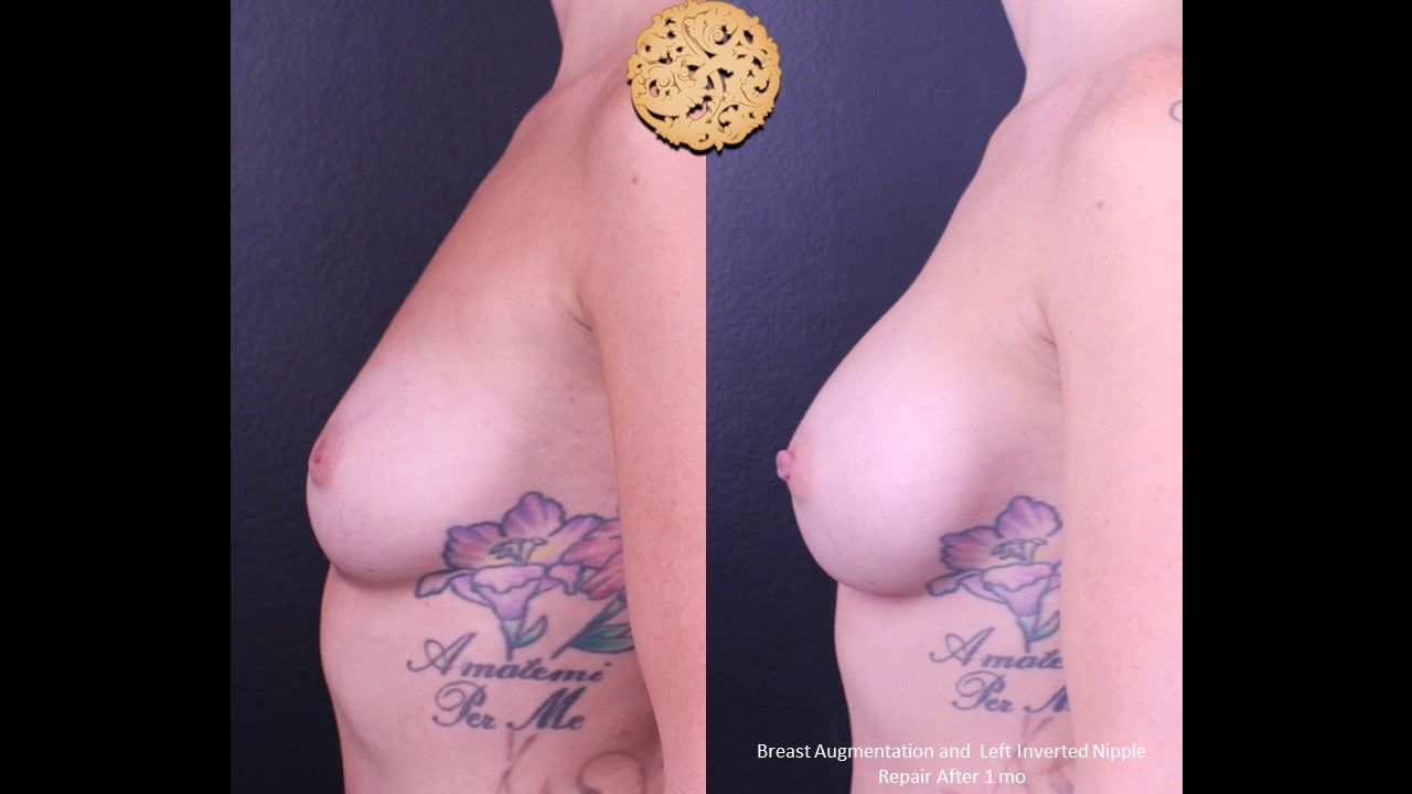 Breast Augmentation before and after - before