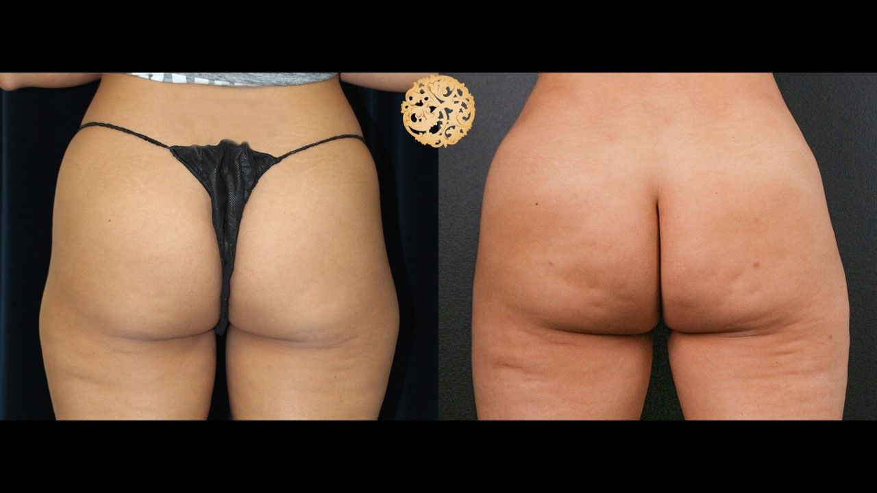 Brazilian Butt Lift before and after - after