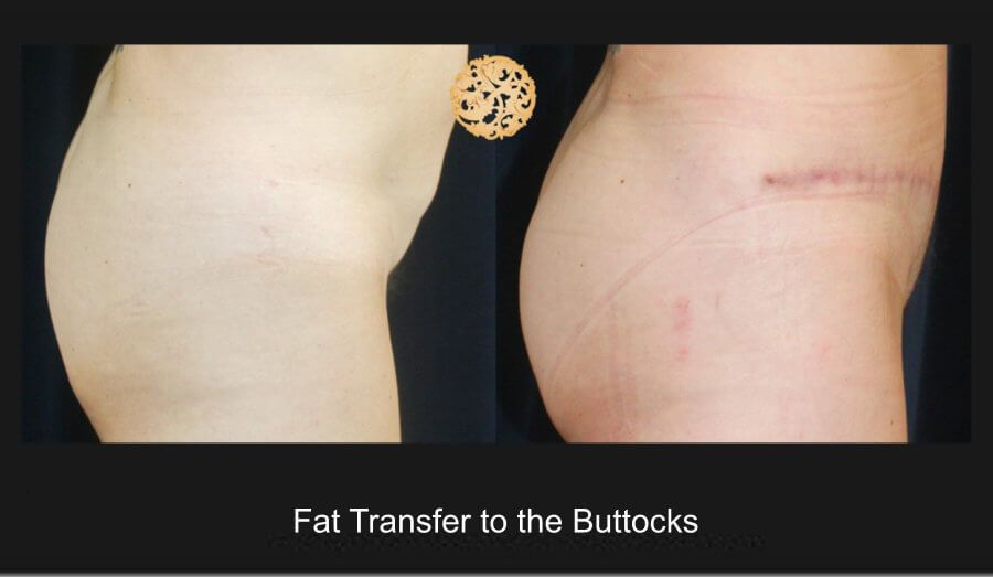 Brazilian Butt Lift before and after - before