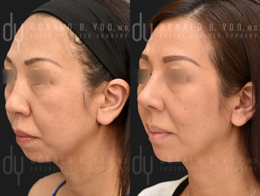 Rhinoplasty and Chin Augmentation before and after - after