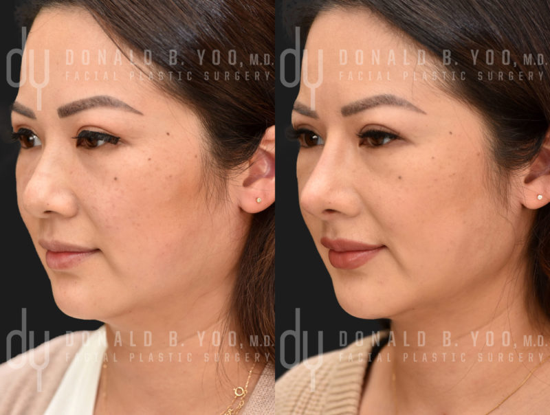 Rhinoplasty and Chin Augmentation before and after - before