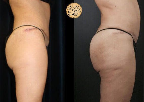 Brazilian Butt Lift before and after - after