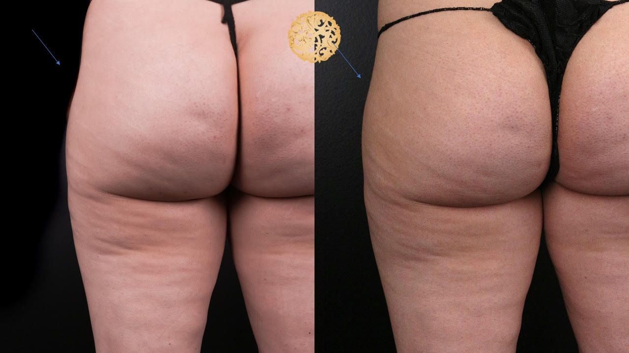 Brazilian Butt Lift before and after - before