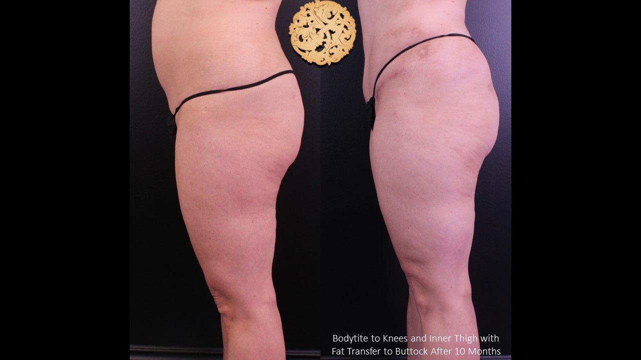 Brazilian Butt Lift before and after - after