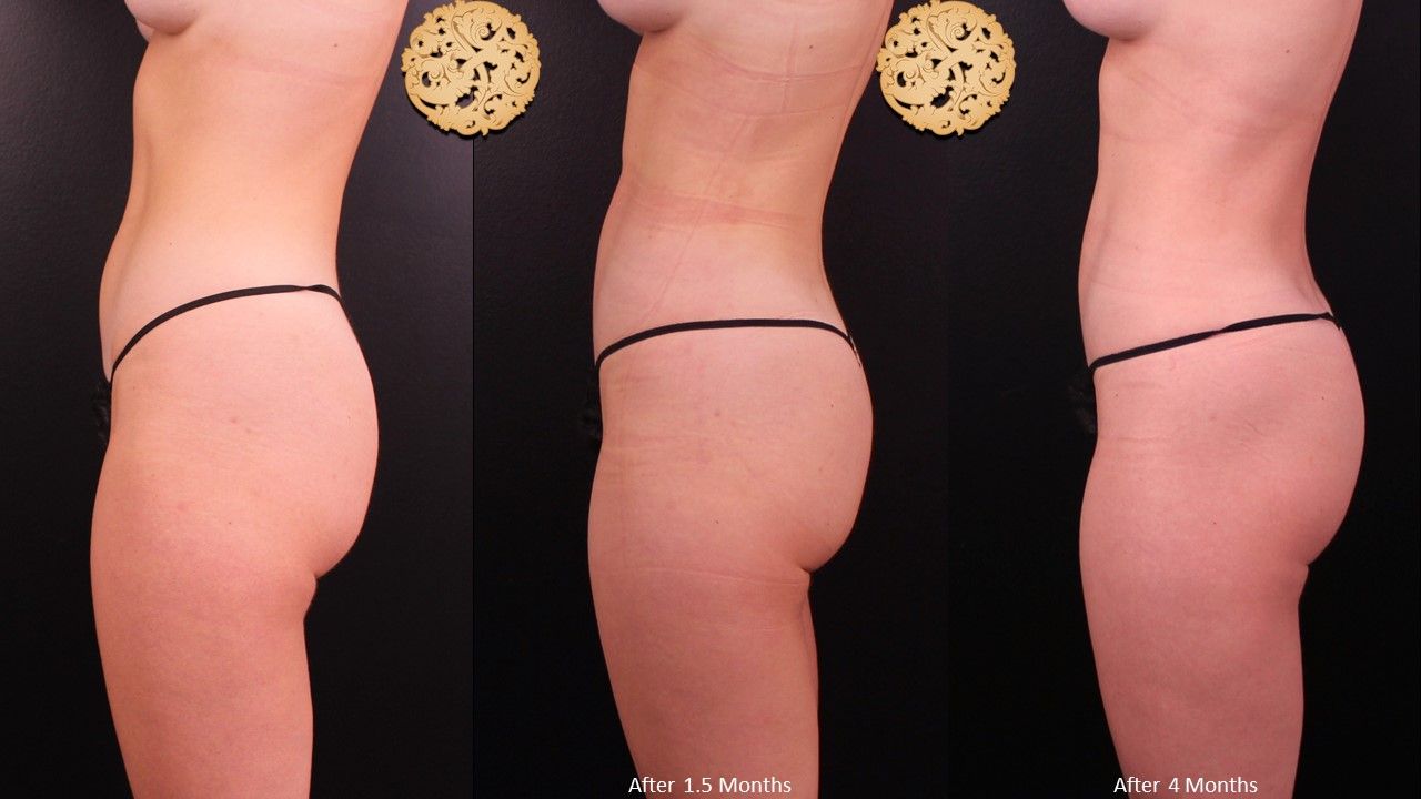 Brazilian Butt Lift before and after - before