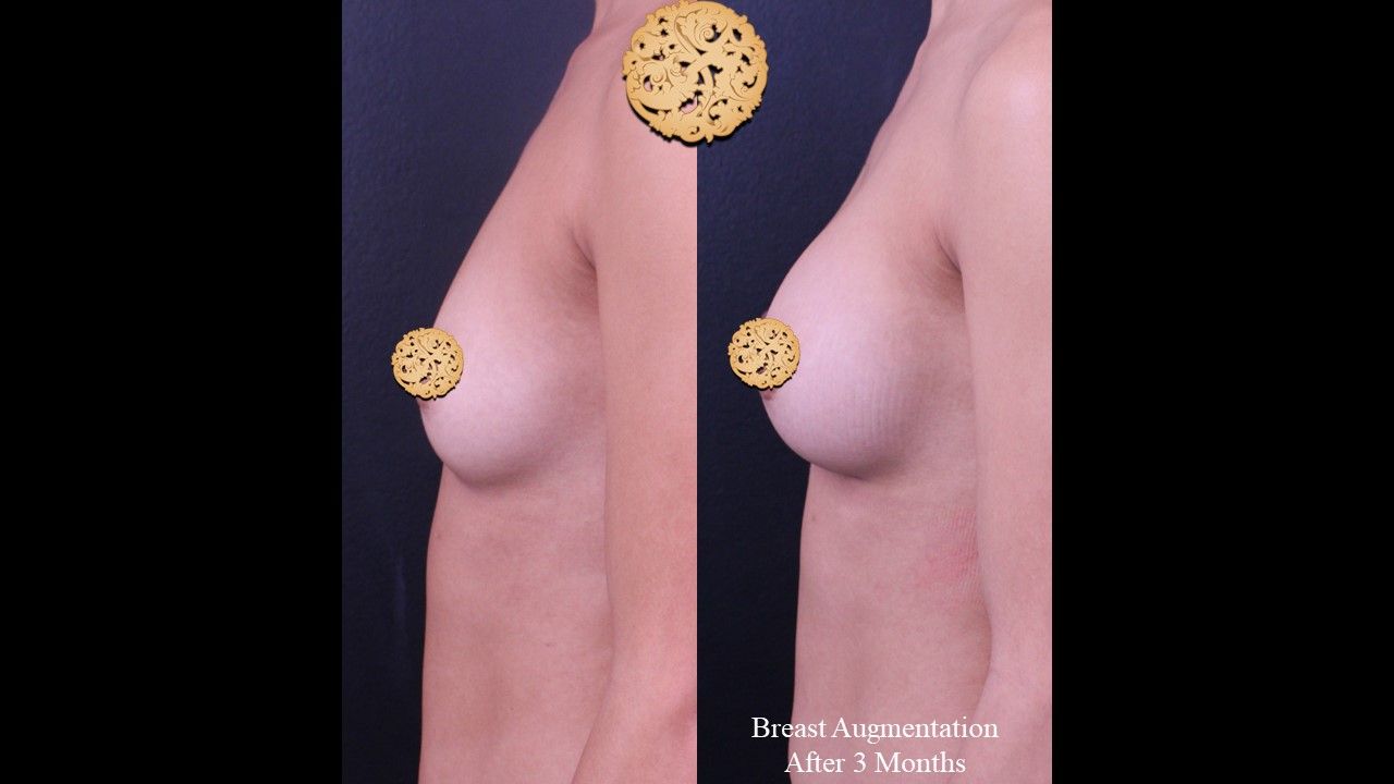Breast Augmentation before and after - after