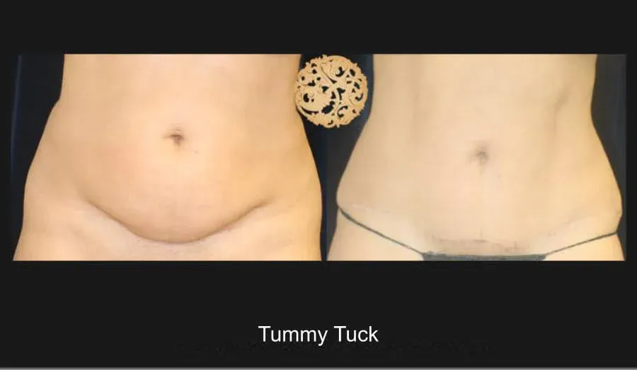Tummy Tuck before and after - after