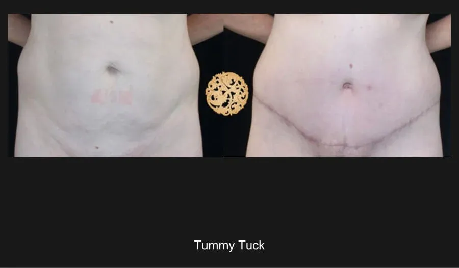 Tummy Tuck before and after - before