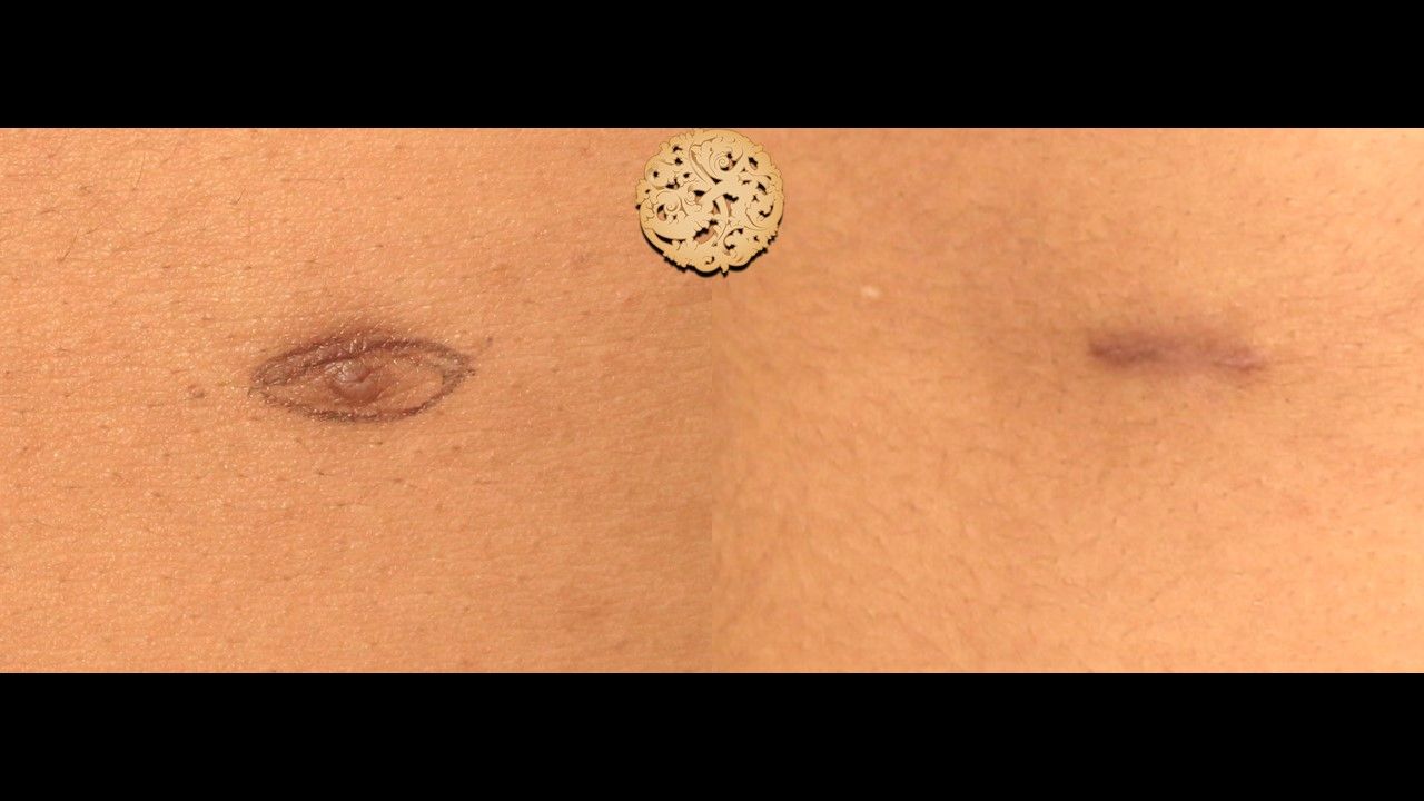 Accessory Nipple Removal before and after - after