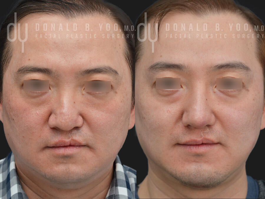Rhinoplasty and Chin Augmentation before and after - after