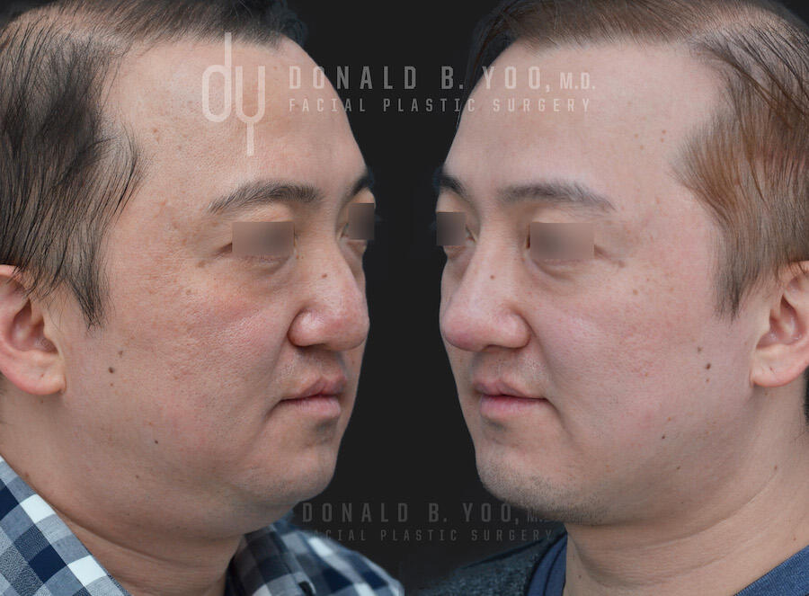 Rhinoplasty and Chin Augmentation before and after - before