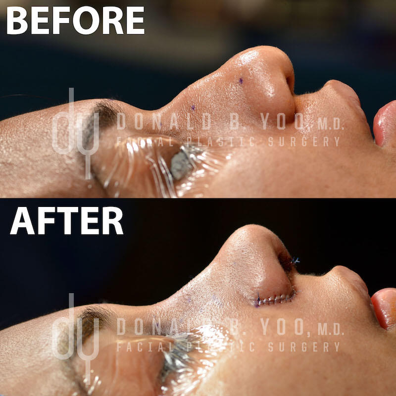 Rhinoplasty before and after - after
