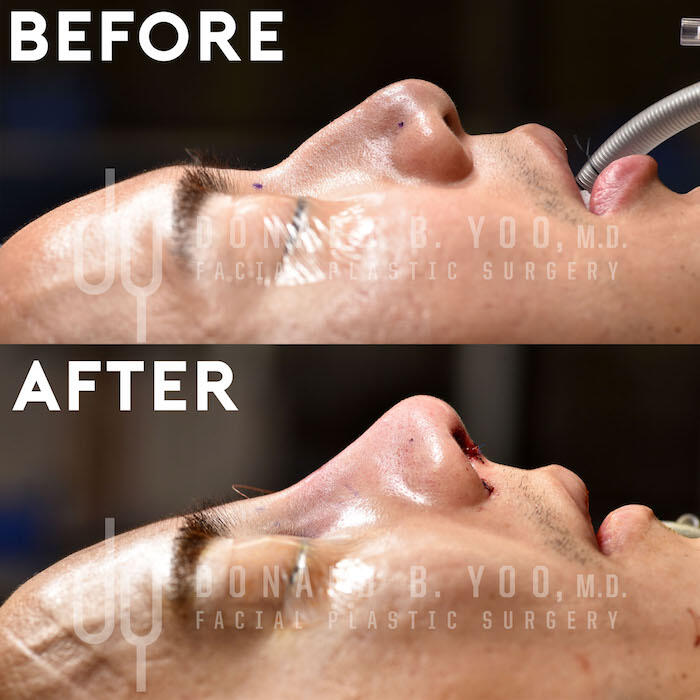 Rhinoplasty before and after - before