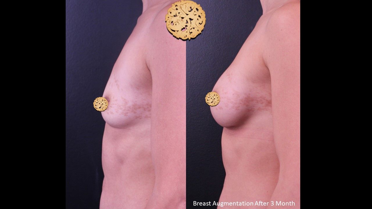 Breast Augmentation before and after - before