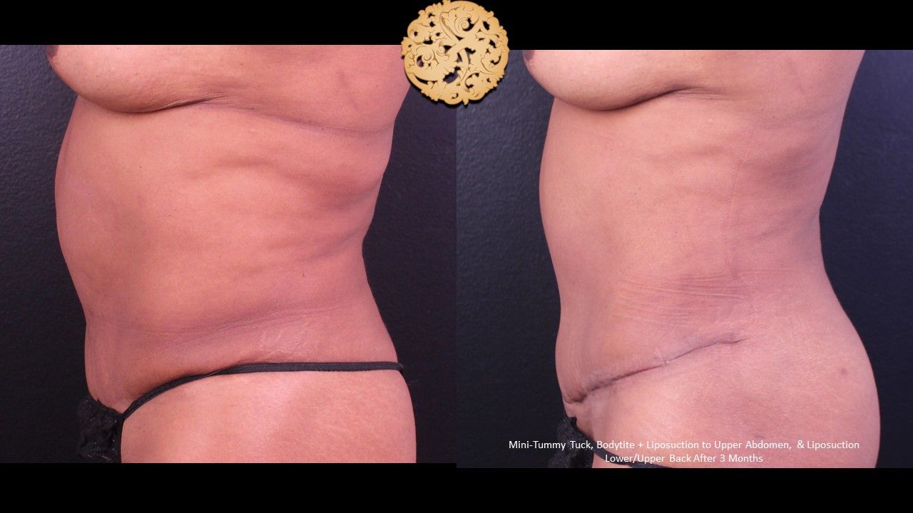 Mini Tummy Tuck before and after - after
