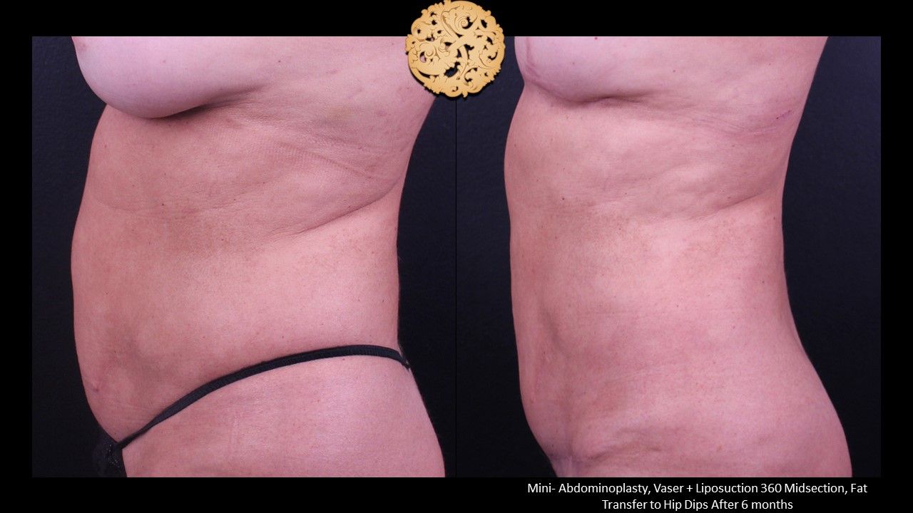 Mini Tummy Tuck before and after - before