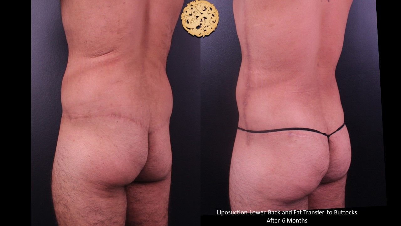 Brazilian Butt Lift before and after - after