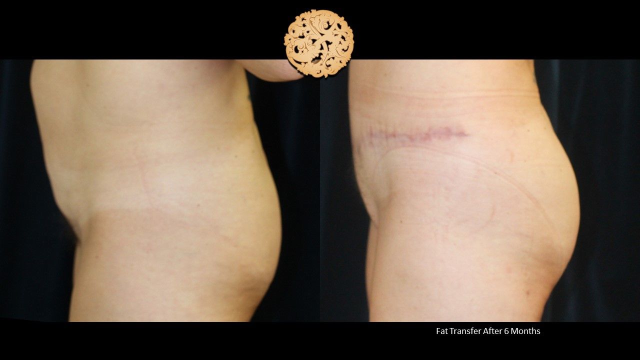 Brazilian Butt Lift before and after - before