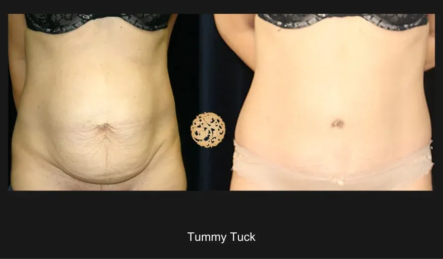 Tummy Tuck before and after - after