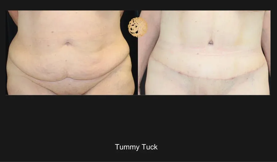 Tummy Tuck before and after - before
