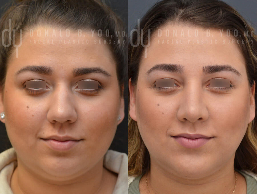 Rhinoplasty and Chin Augmentation before and after - after