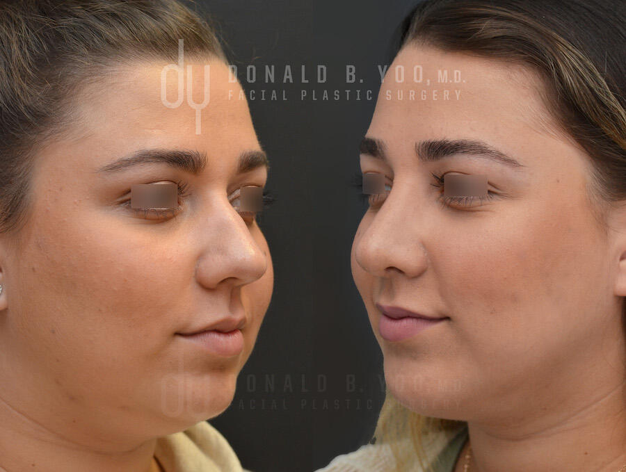 Rhinoplasty and Chin Augmentation before and after - before