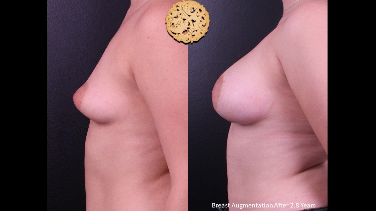 Breast Augmentation before and after - after