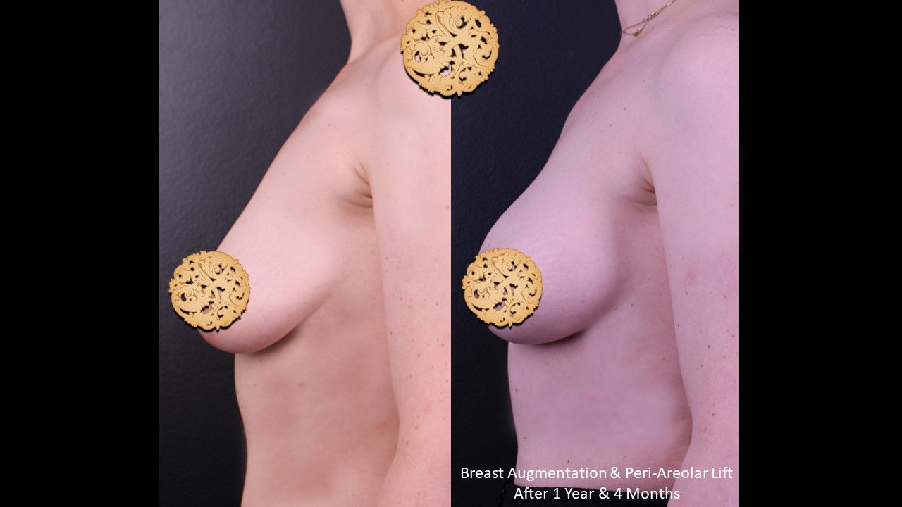 Breast Augmentation before and after - before