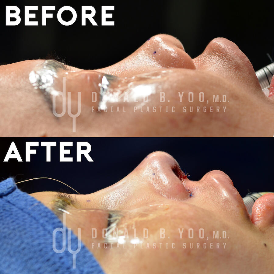 Rhinoplasty before and after - after