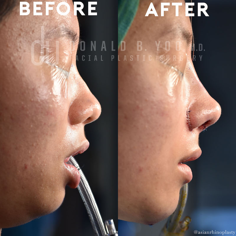 Rhinoplasty before and after - before