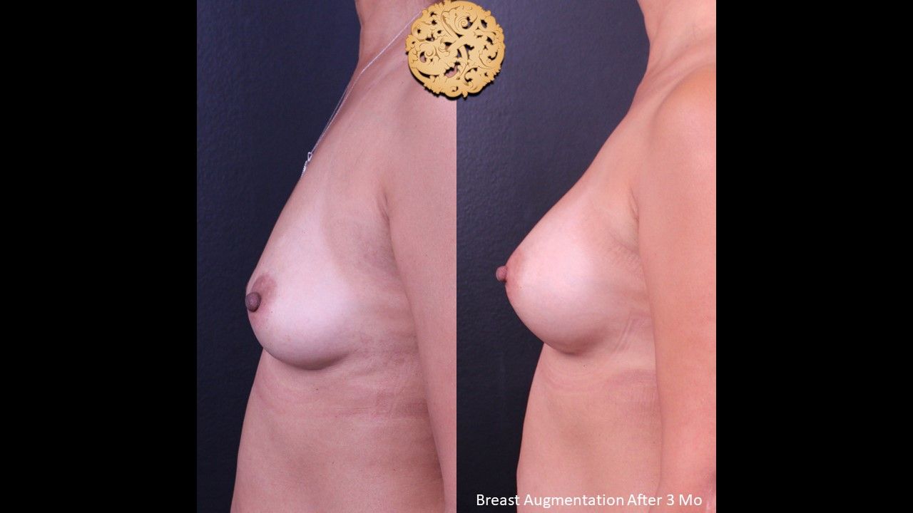 Breast Augmentation before and after - after