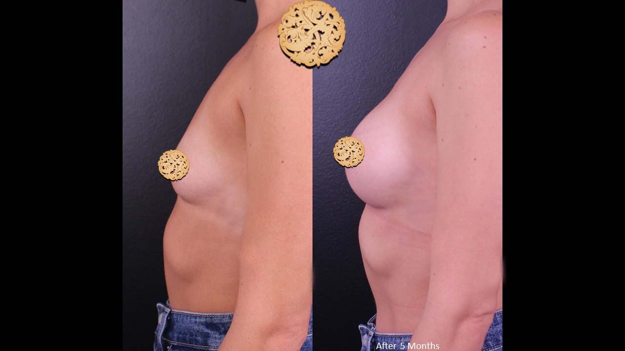 Breast Augmentation before and after - before