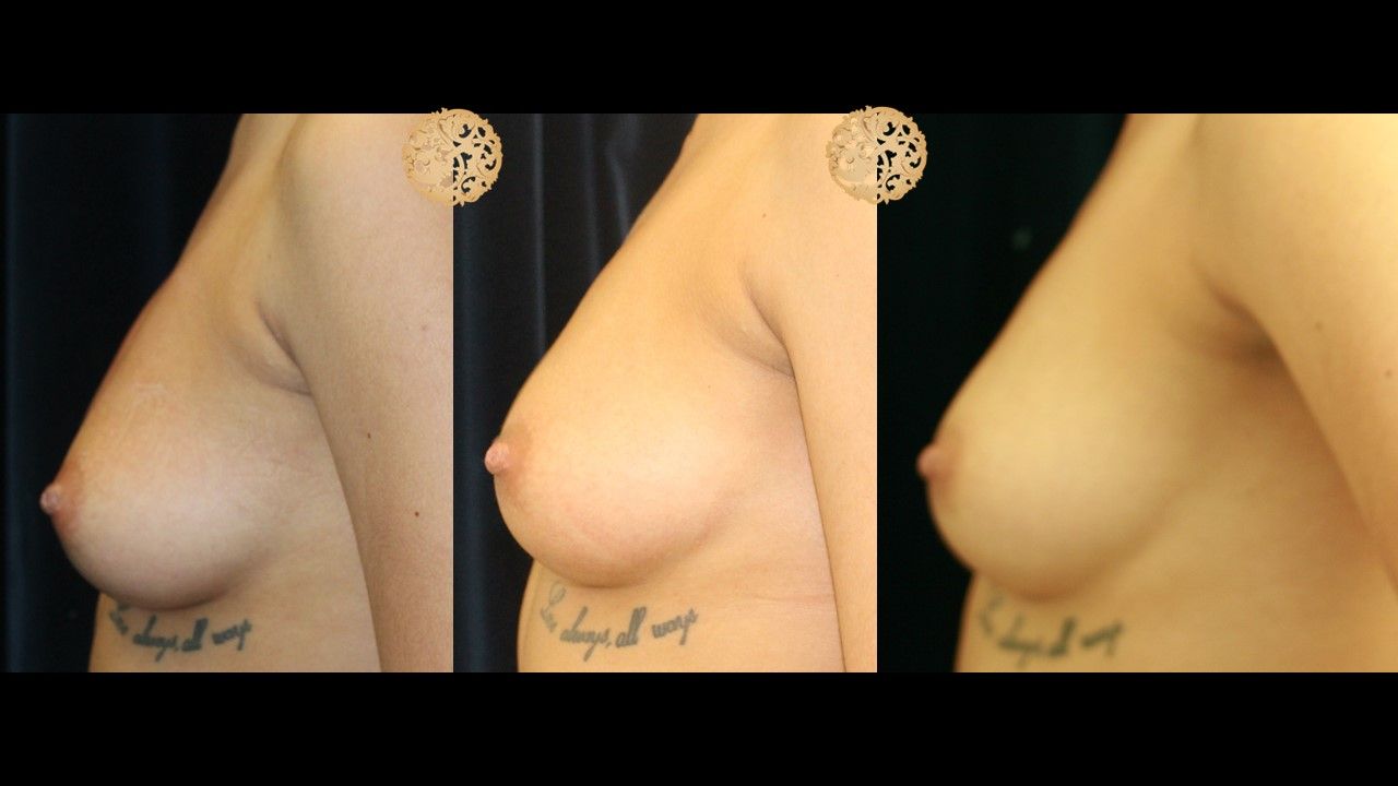 PRP Breast Booster before and after - before