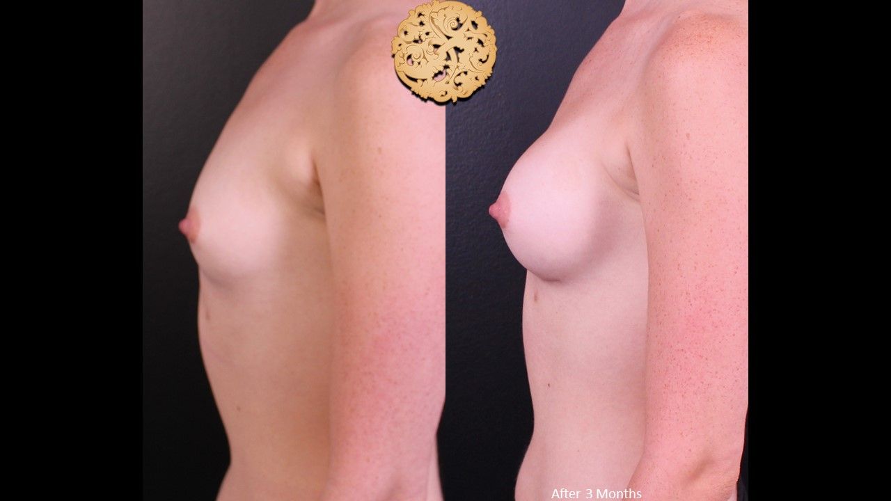 Breast Augmentation before and after - before