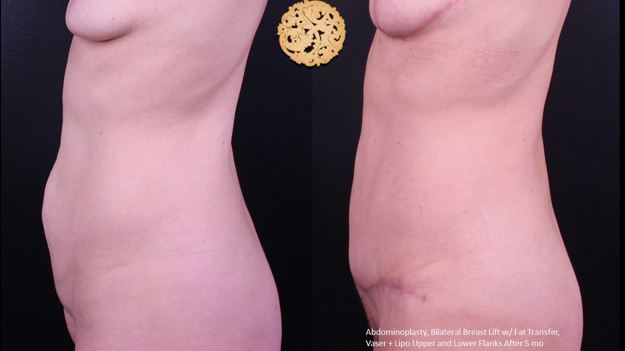 Tummy Tuck before and after - after