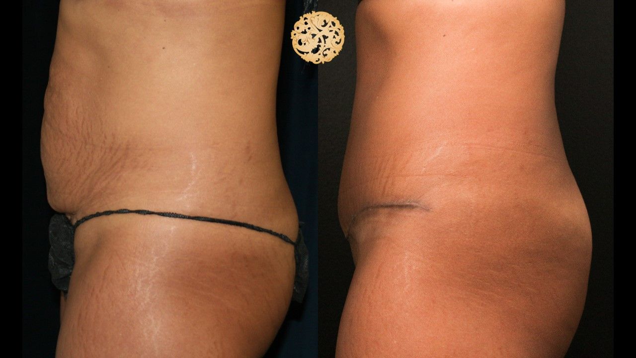 Tummy Tuck before and after - before