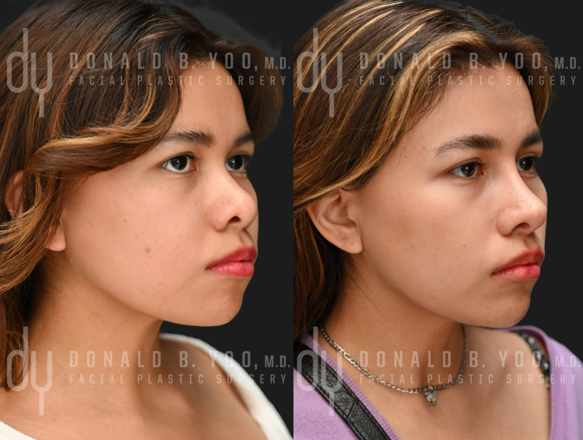 Rhinoplasty and Chin Augmentation before and after - after